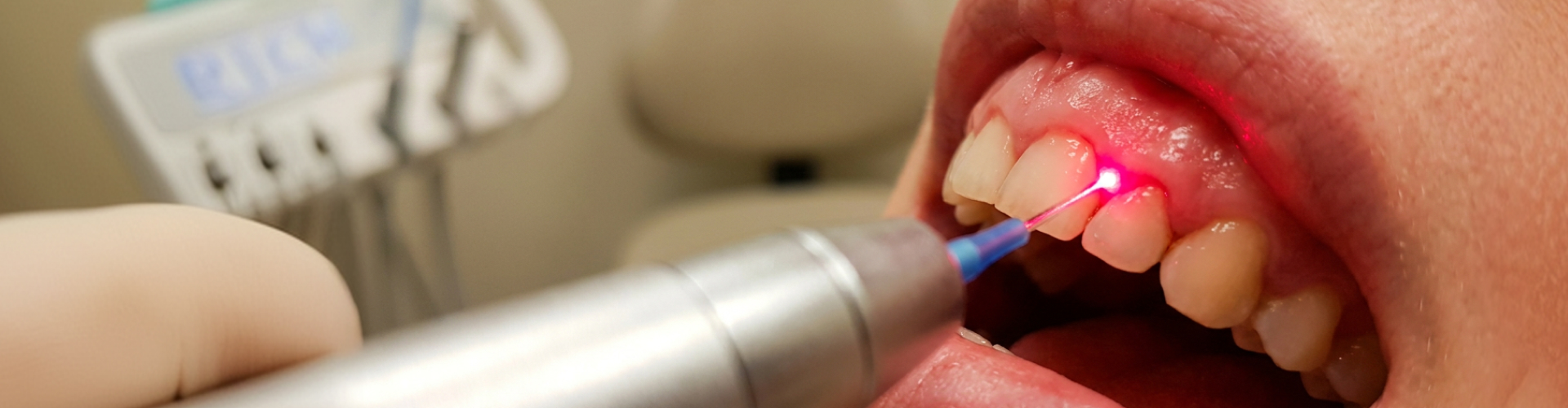 Laser gum contouring treatment at Bellflower Dental Group to reshape the gumline and improve smile aesthetics.